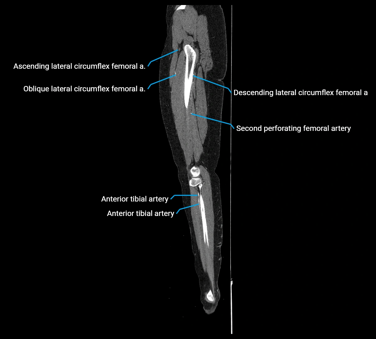CTA lower limb sagittal cross sectional anatomy labelled image _56 (3).webp